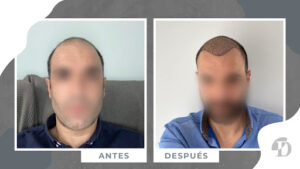Injerto Capilar en Valencia Dr. Devesa