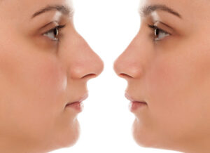Dr Eduardo Simon- Rinoplastia