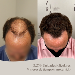 ZIRA Medicina capilar