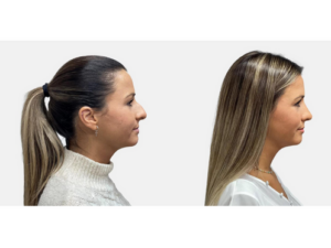 Dr. Sebastián Moya Rinoplastia